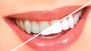 Smile Makeover Dentist